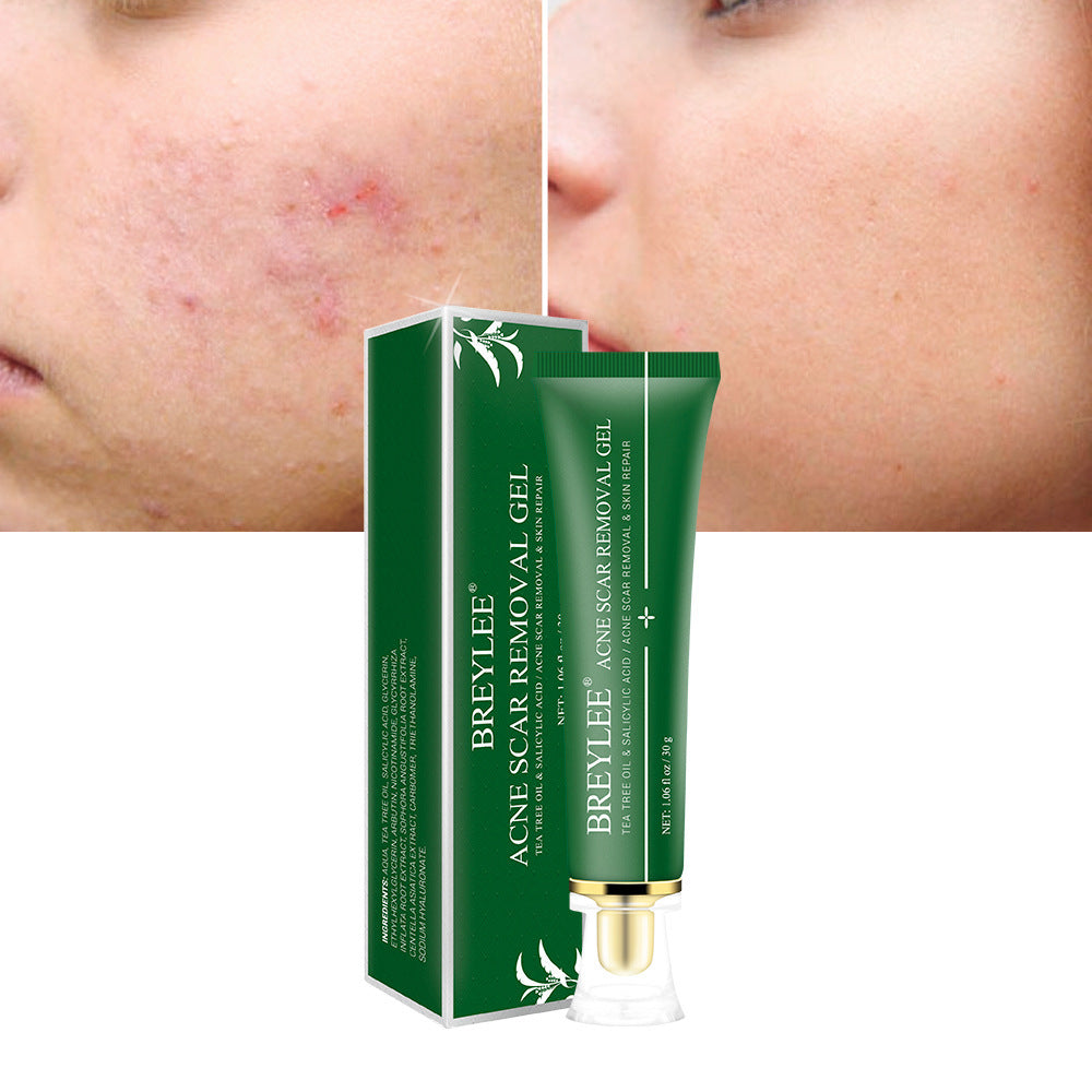 Acne Scar Gel visibly reduces marks and prevents new breakouts.