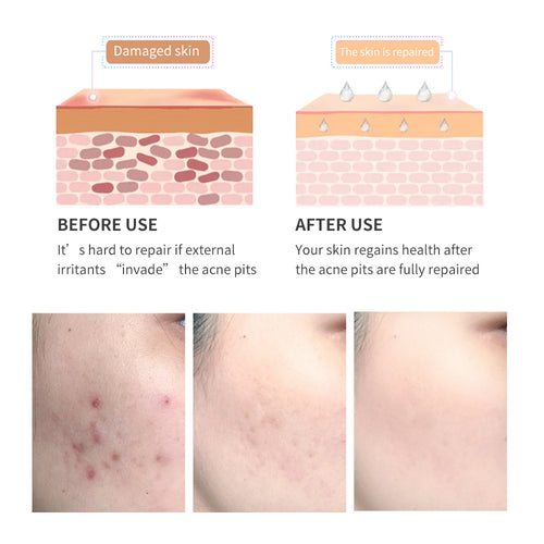 Acne Scar Gel visibly reduces marks and prevents new breakouts.