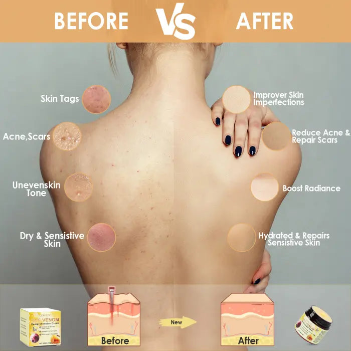 Bee venom cream before and after skin results showing reduced acne, even tone, and hydration.