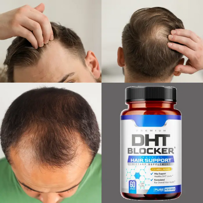 Collage showing hair loss progression and results with DHT Blocker supplement bottle in focus, highlighting hair restoration benefits.