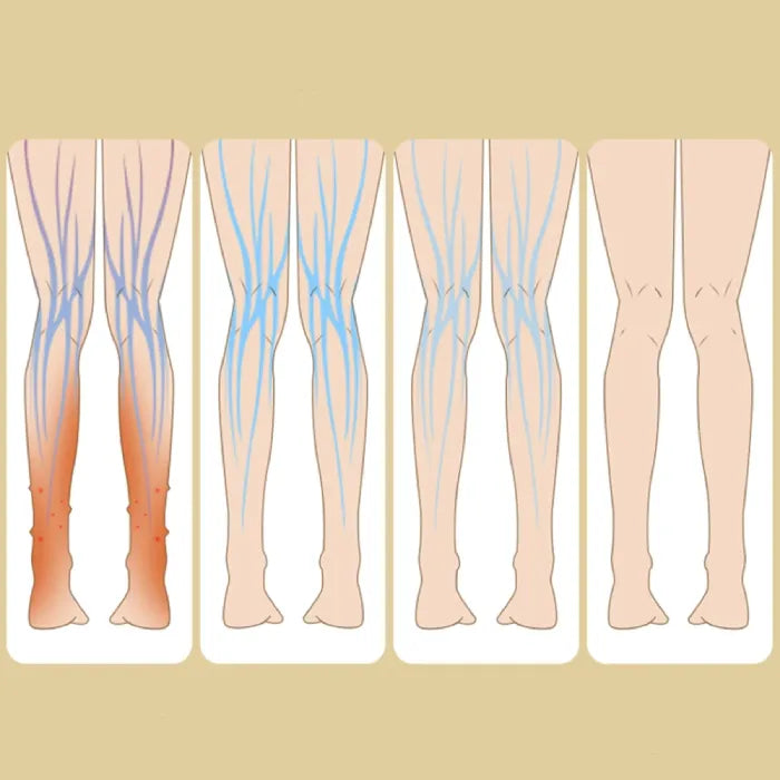 Medical diagram showing four stages of varicose vein treatment progression from severe to treated legs