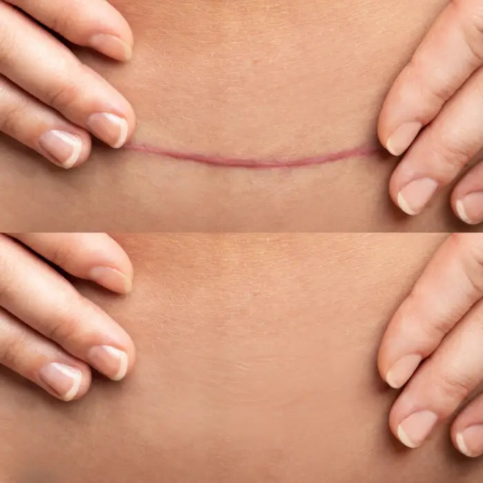 Before and after results of surgical scar camouflage patch showing complete coverage and natural skin appearance